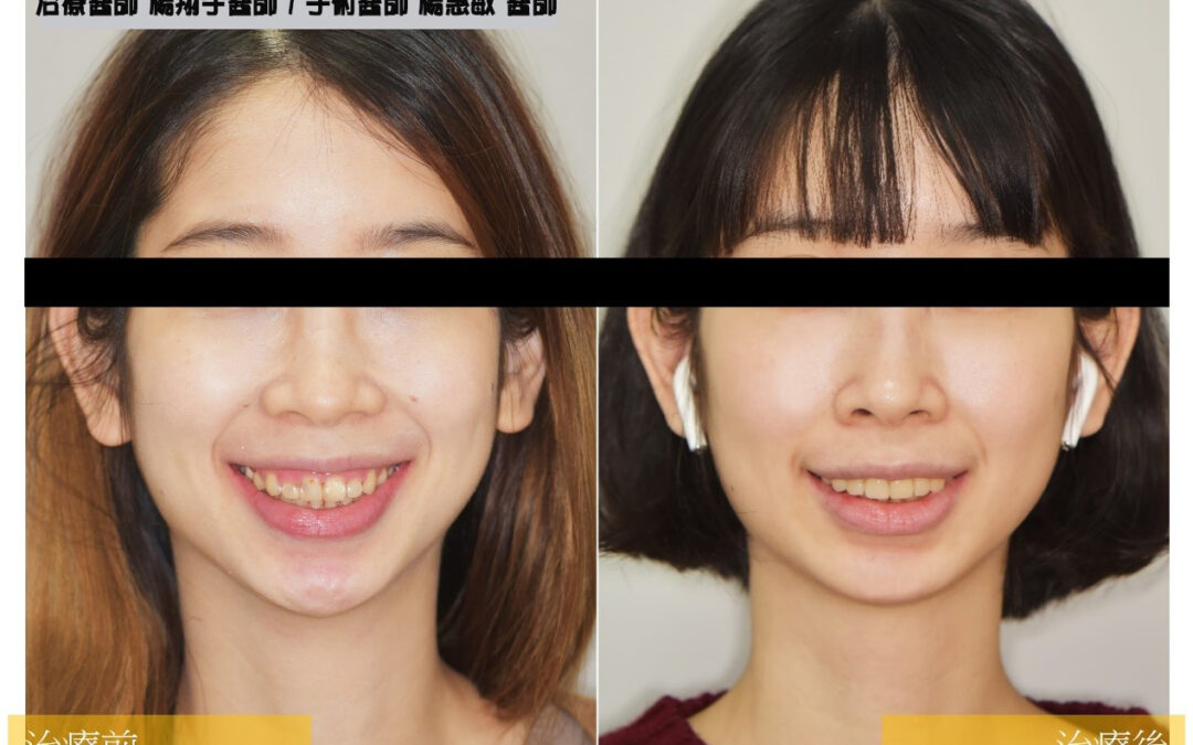 牙齒矯正美學案例 – 前牙牙冠增長術及陶瓷貼片修復- 跨科合作案例 (前牙貼片與牙冠增長手術)