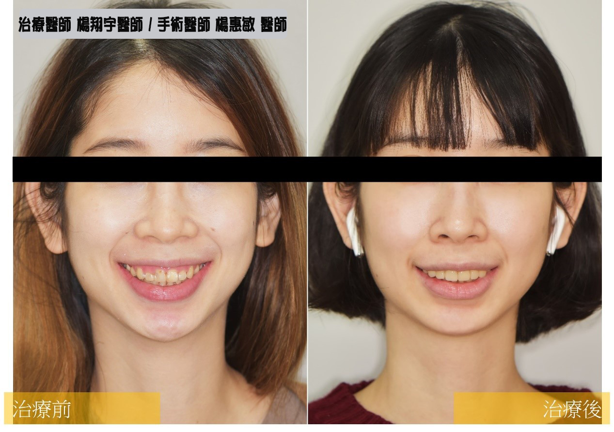 牙齒矯正美學案例 – 前牙牙冠增長術及陶瓷貼片修復- 跨科合作案例 (前牙貼片與牙冠增長手術)